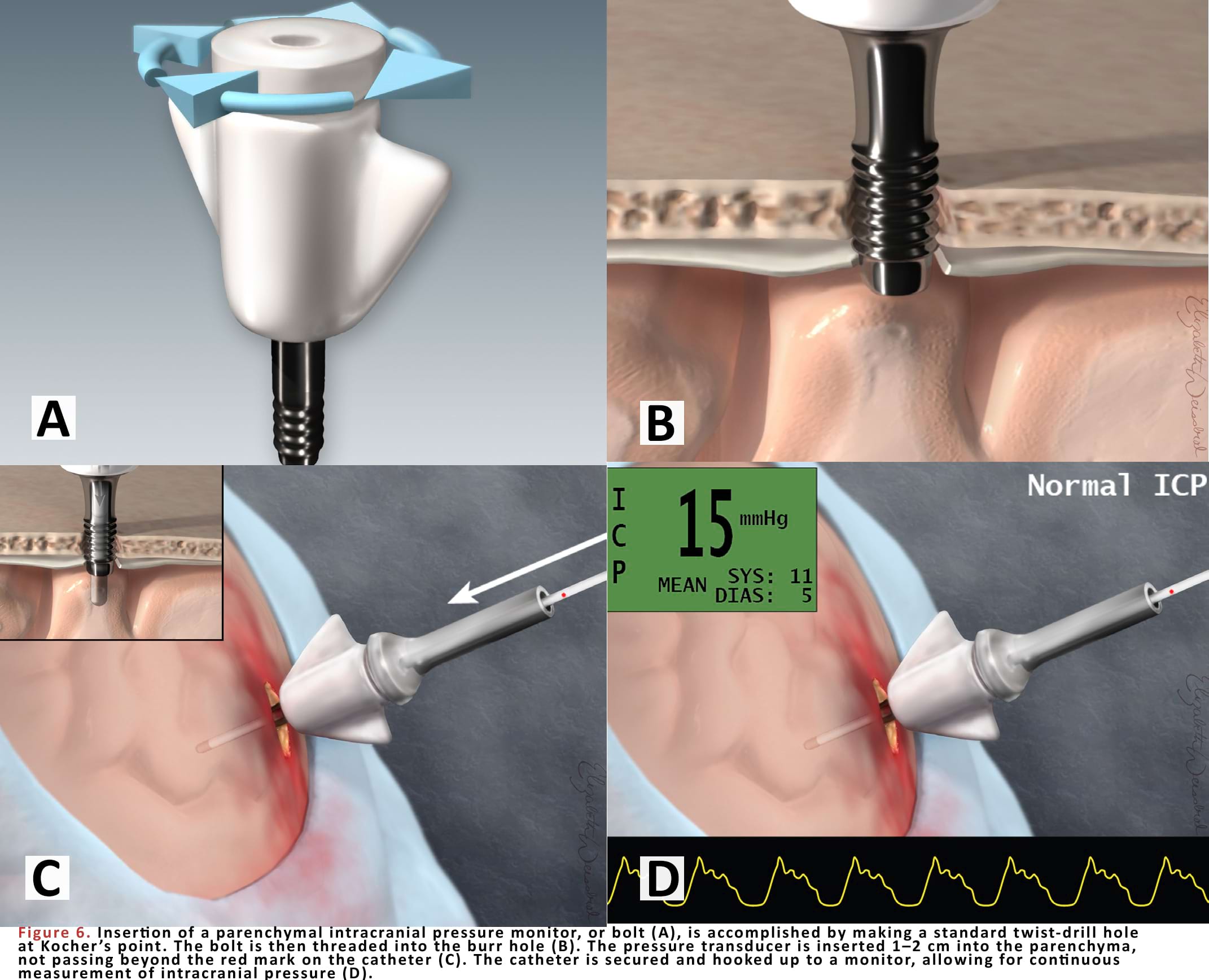 Insertion of a parenchymal intracranial pressure monitor, or bolt (A), is accomplished by making a standard twist-drill hole at Kocher’s point.