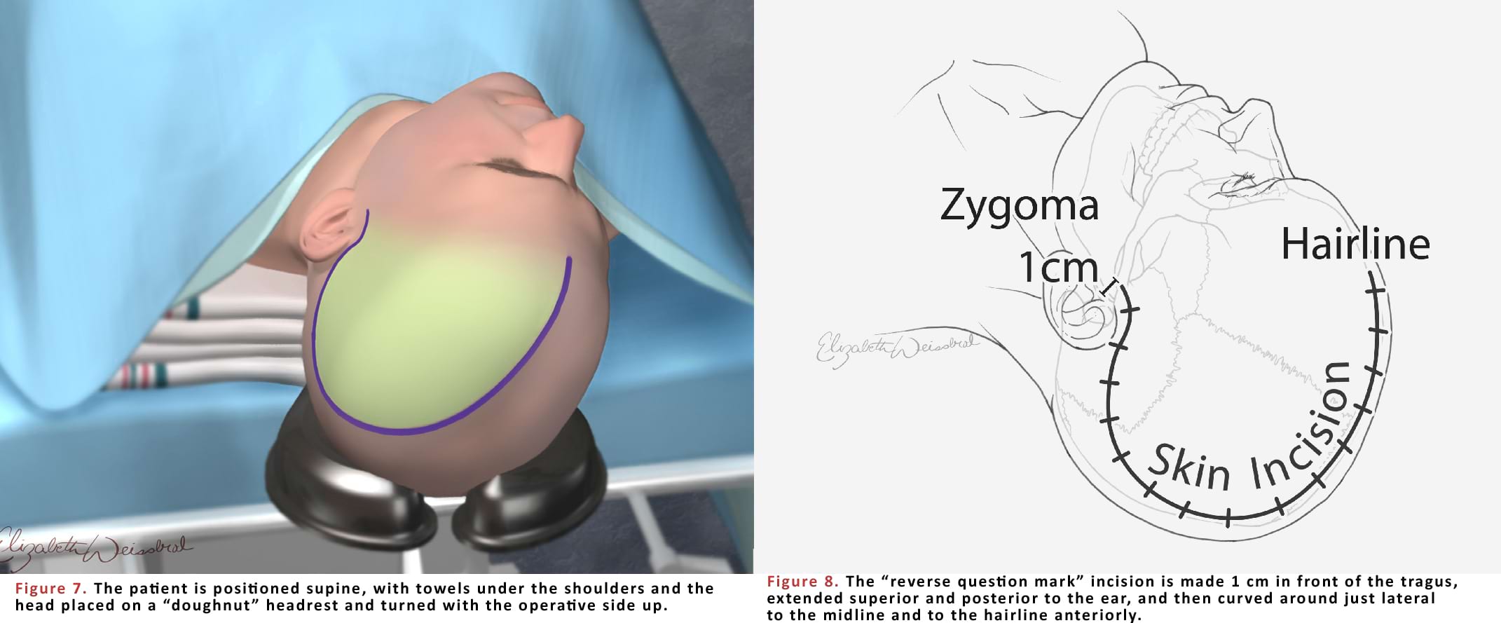 The “reverse question mark” incision is made 1 cm in front of the tragus, extended superior and posterior to the ear, and then curved around just lateral to the midline and to the hairline anteriorly