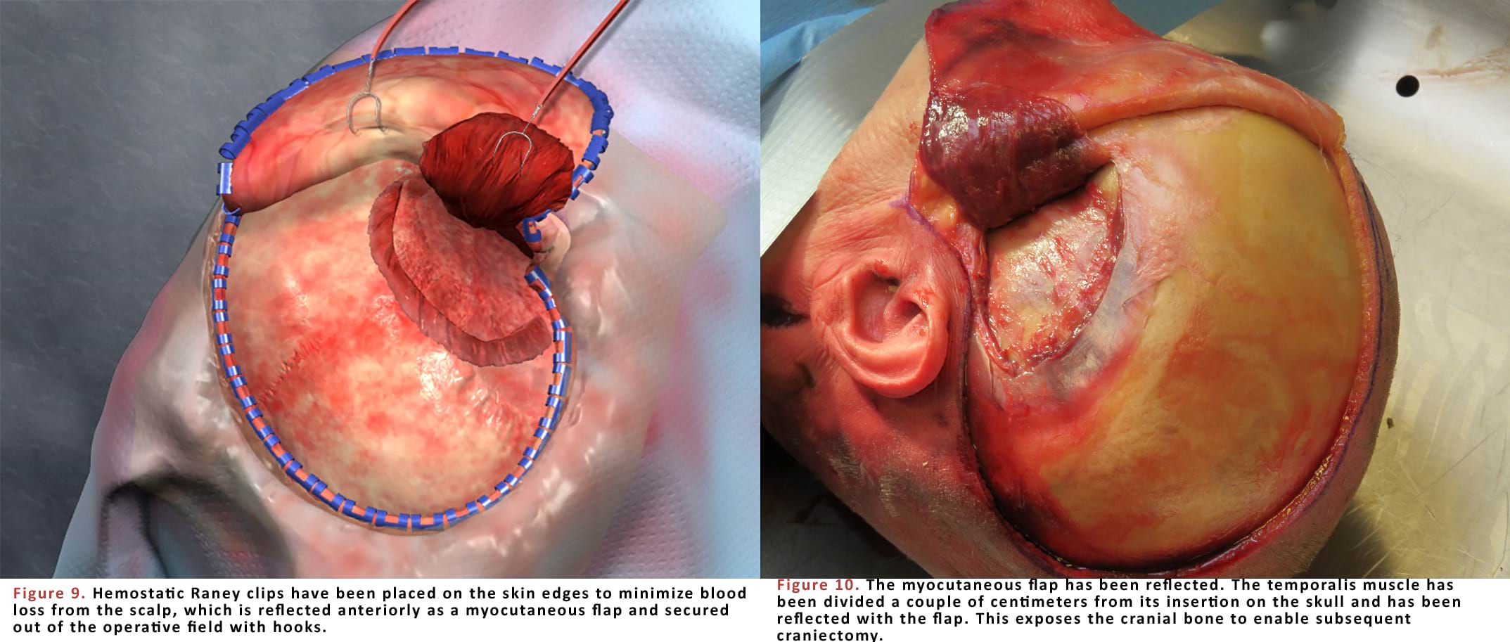 Hemostatic Raney clips have been placed on the skin edges to minimize blood loss from the scalp, which is reflected anteriorly as a myocutaneous flap and secured out of the operative field with hooks