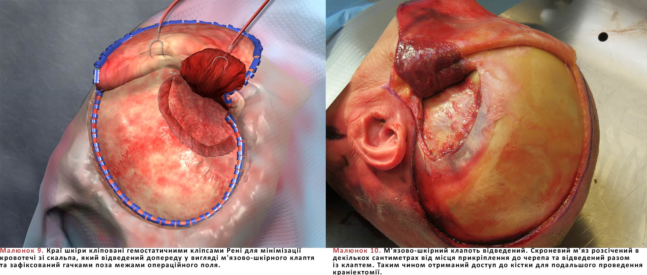 Краї шкіри кліповані гемостатичними кліпсами Рені для мінімізації кровотечі зі скальпа