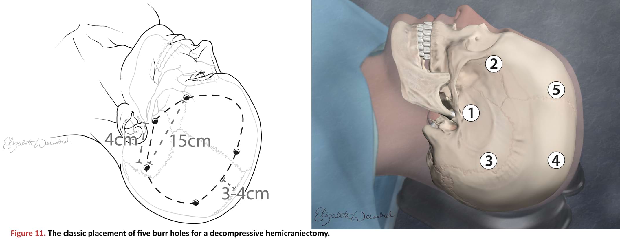 The classic placement of five burr holes for a decompressive hemicraniectomy