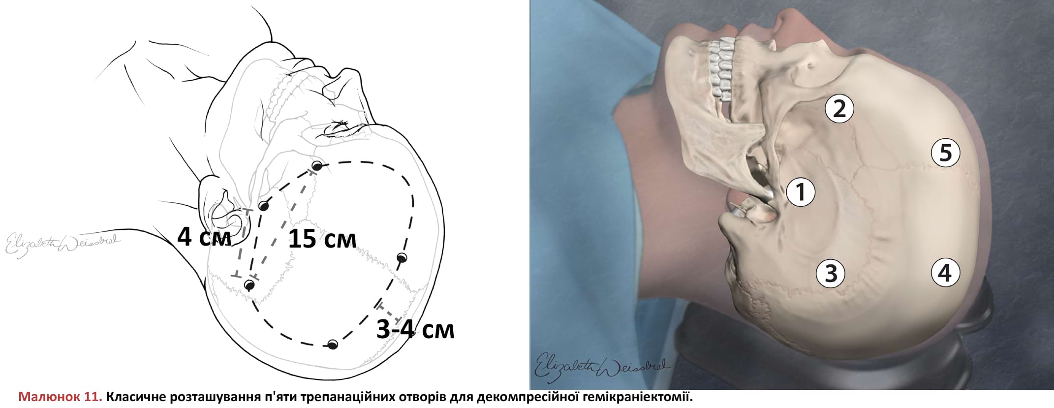 Класичне розташування п'яти трепанаційних отворів для декомпресійної гемікраніектомії