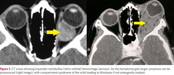 CT scans showing traumatic retrobulbar haemorrhage