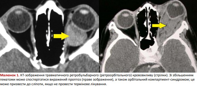 КТ-зображення травматичного ретробульбарного крововиливу