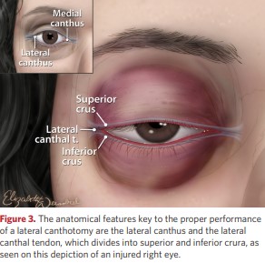 Anatomical features key for performing lateral cantotomy