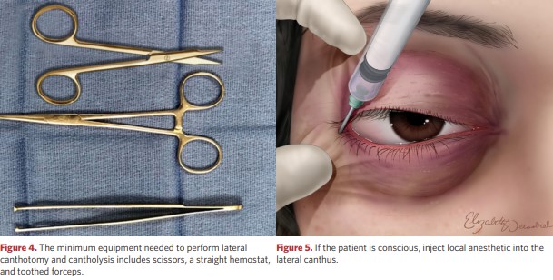 Equipment needed to perform lateral canthotomy and cantholysis