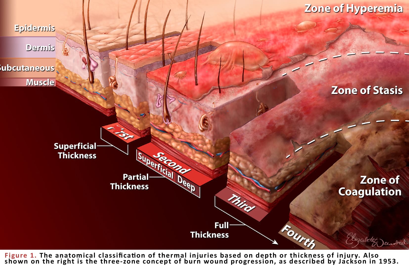 The anatomical classification of thermal injuries