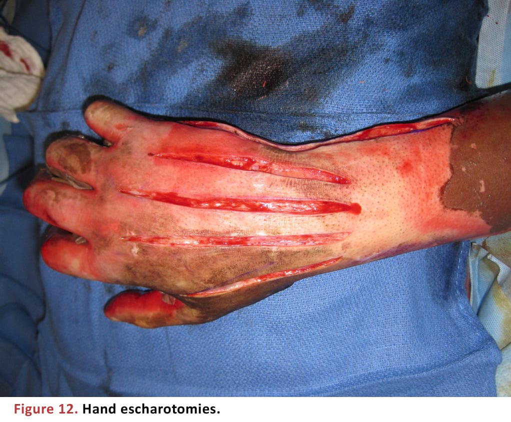 Hand escharotomies