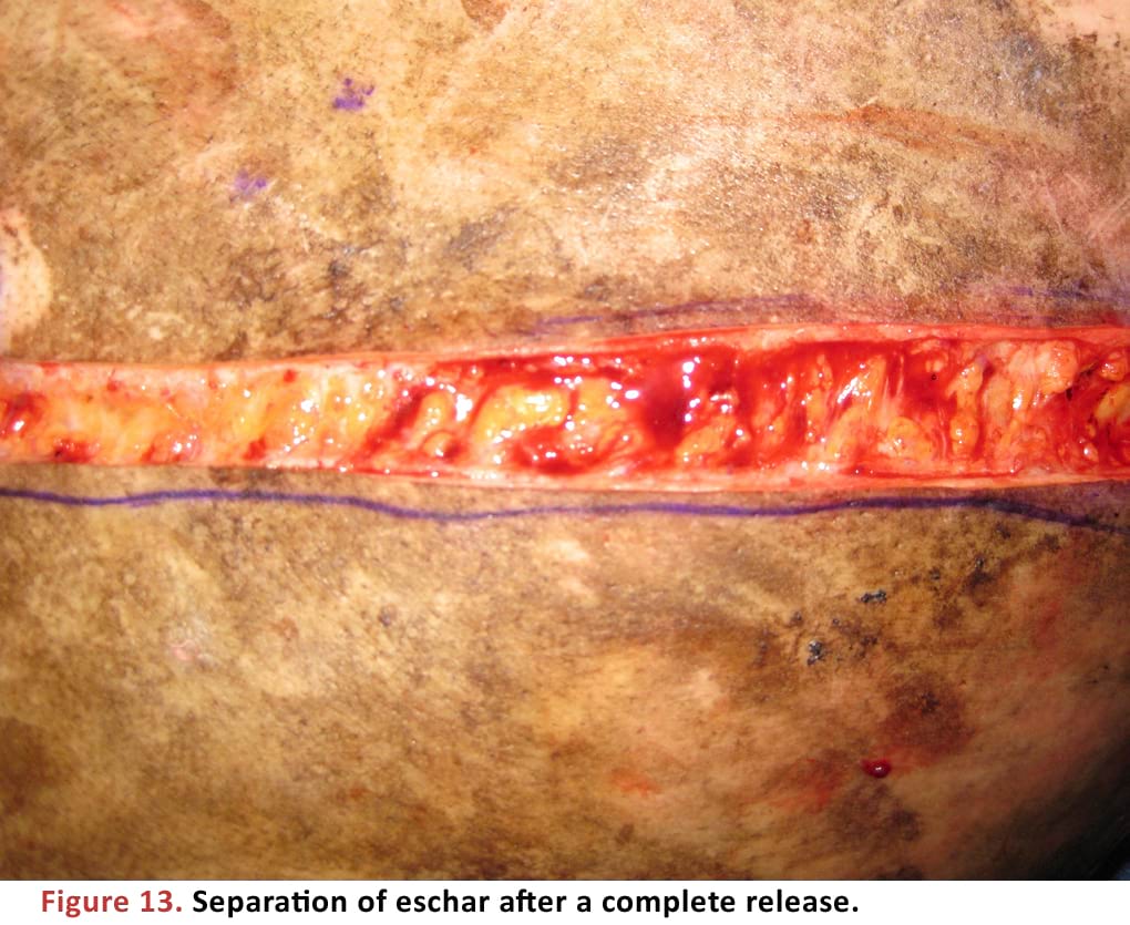 Separation of eschar after a complete release