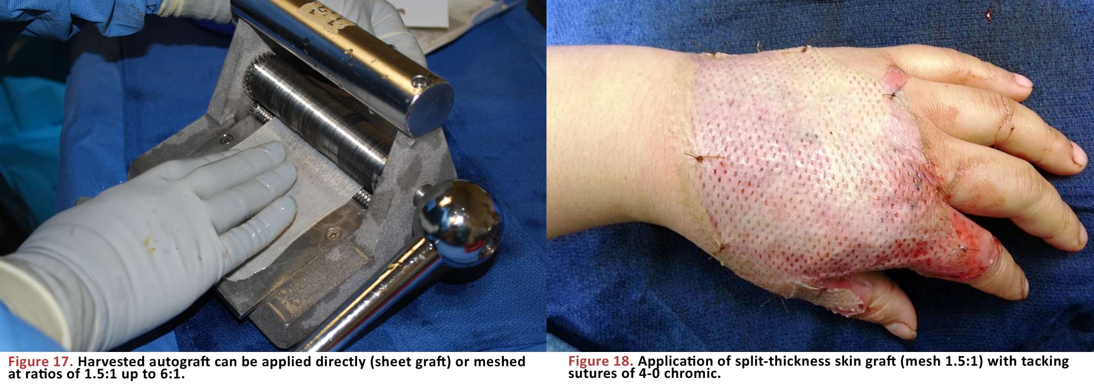 Application of split-thickness skin graft