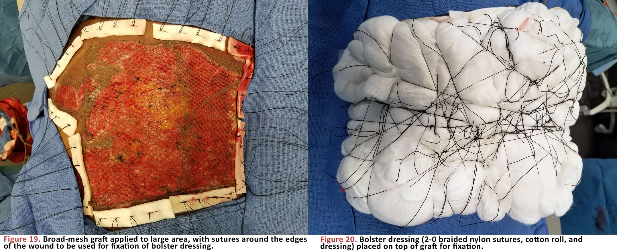 Broad-mesh graft