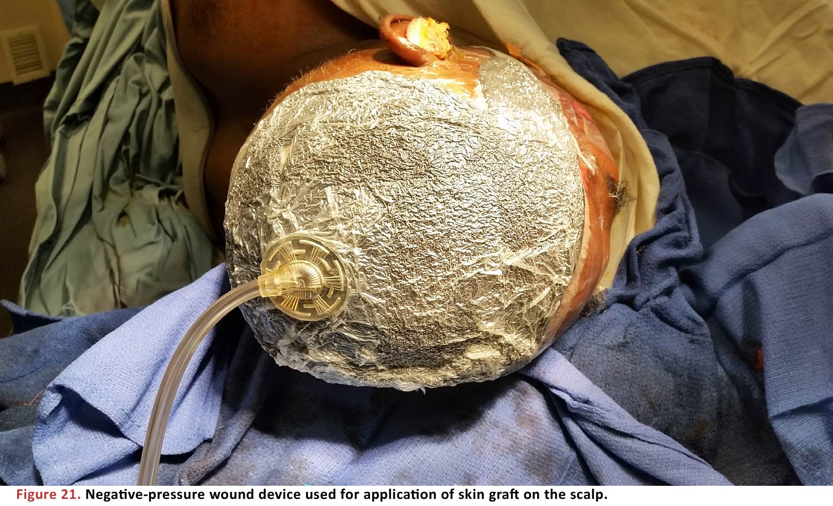 Negative-pressure wound device used for application of skin graft on the scalp