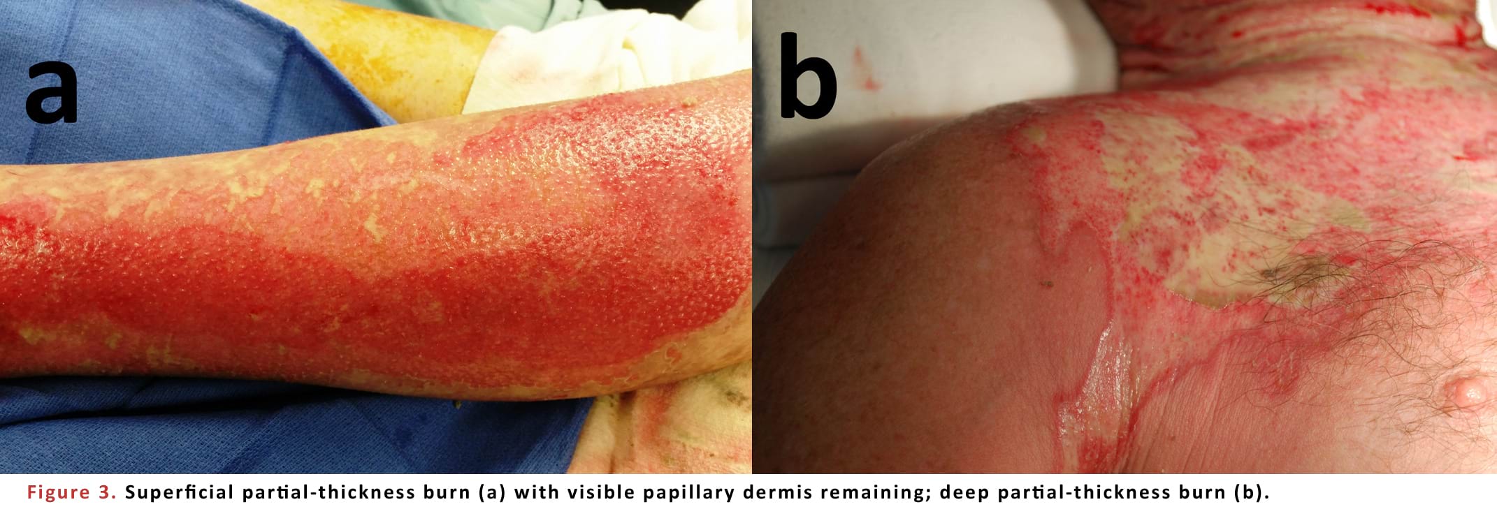 Superficial partial-thickness burn; deep partial-thickness burn