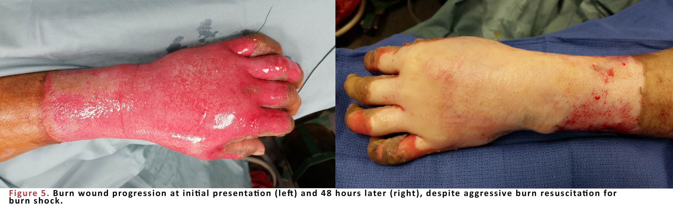 Burn wound progression at initial presentation and 48 hours later