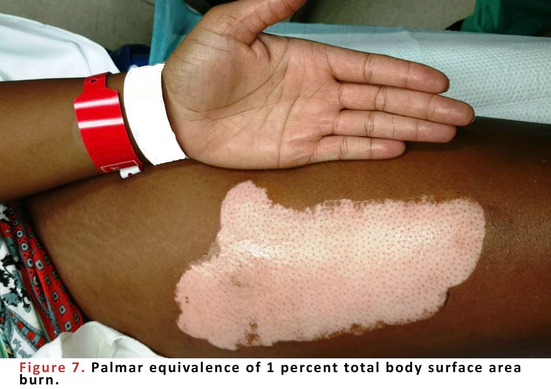 Palmar equivalence of 1 percent total body surface area burn