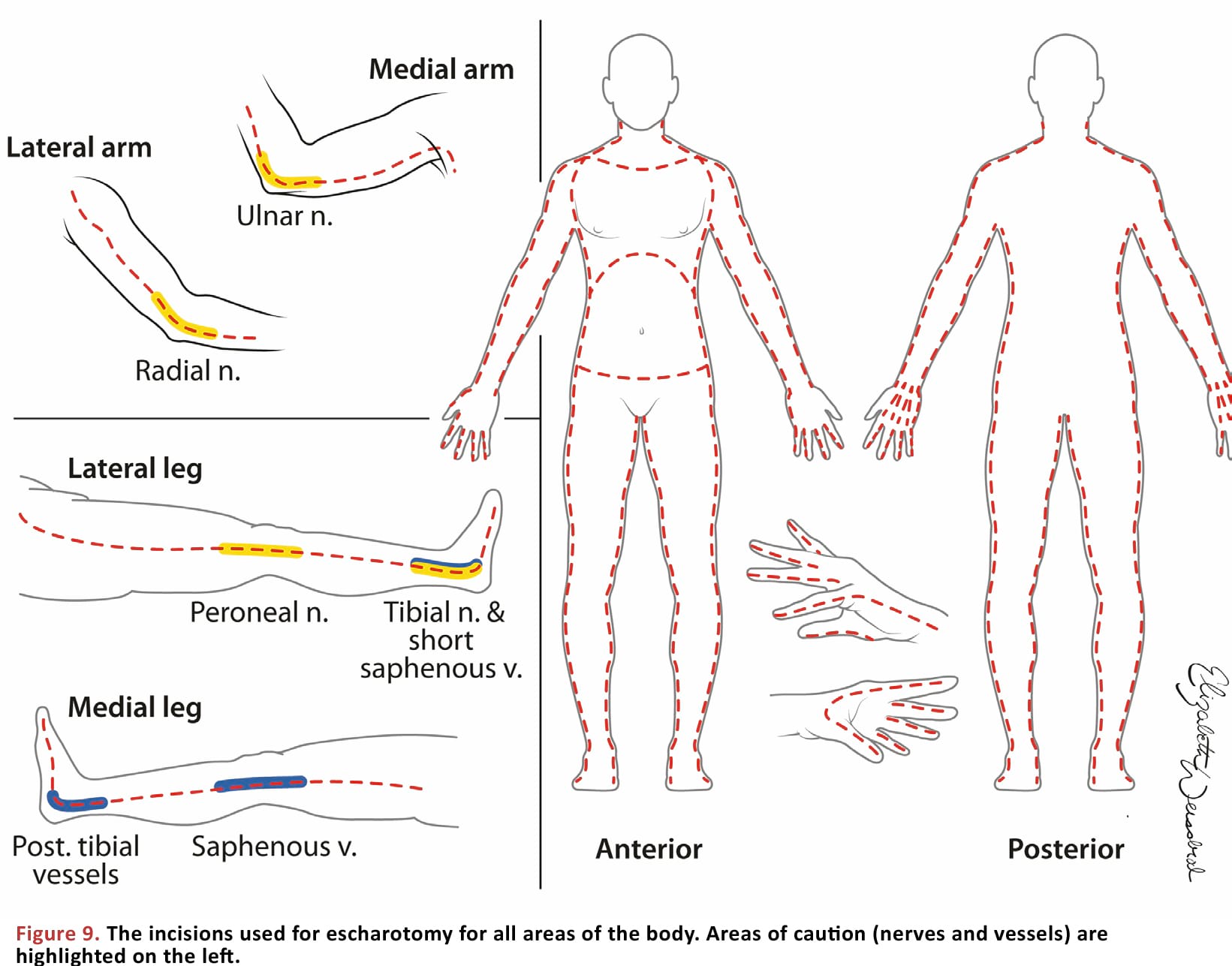 The incisions used for escharotomy for all areas of the body