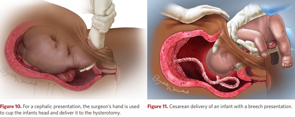 Caesarean section for head and breech presentation of the fetus