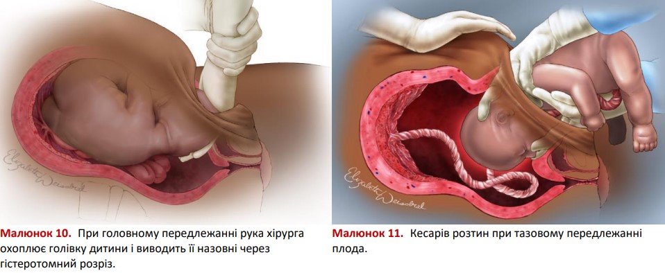 Кесарів розтин при головному та тазовому передлежанні плода