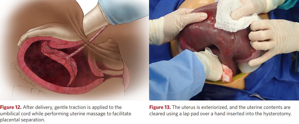 The uterus is brought out and cleaned through the hysterotomy wound