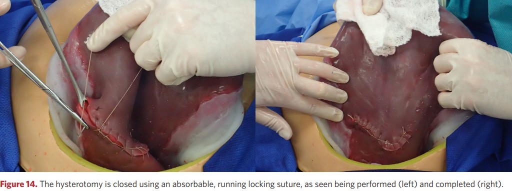 The hysterectomy incision is sutured with absorbable sutures