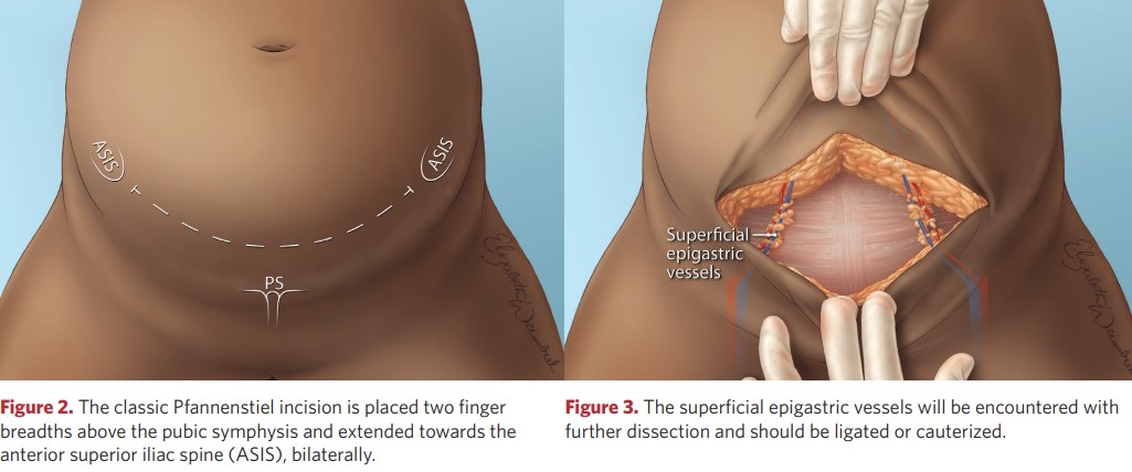 Classic incision according to Pfannenstiel