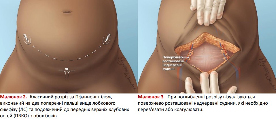 Класичний розріз за Пфанненштілем