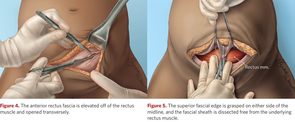 The superior fascial edge is grasped