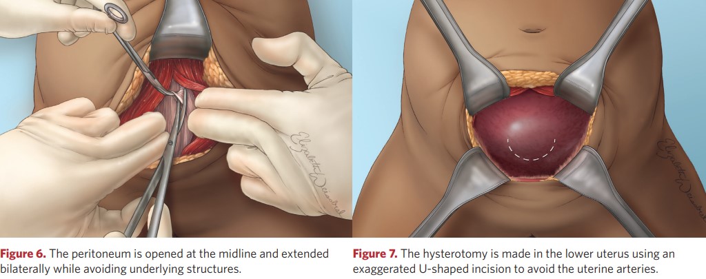 The hysterotomy U-shaped incision