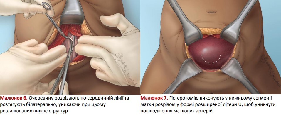 Гістеротомія у формі розширеної літери U