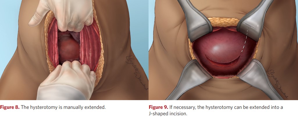 The hysterotomy is manually extended