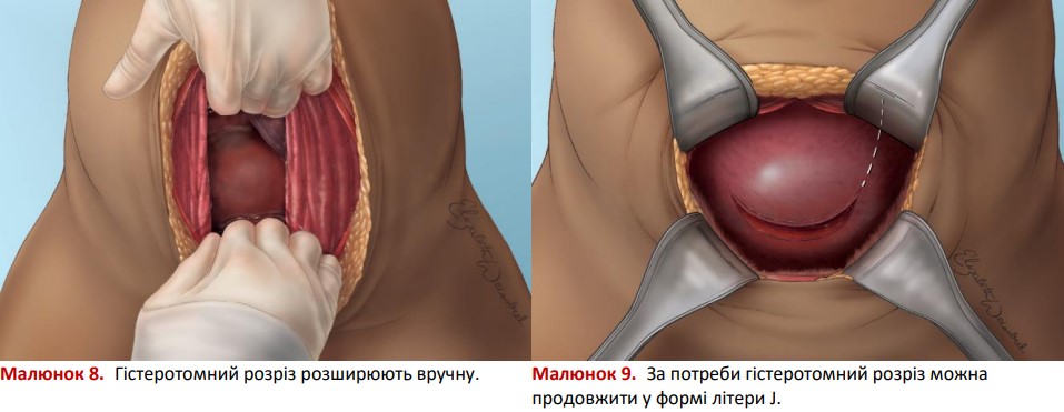 Гістеротомний розріз розширюють вручну