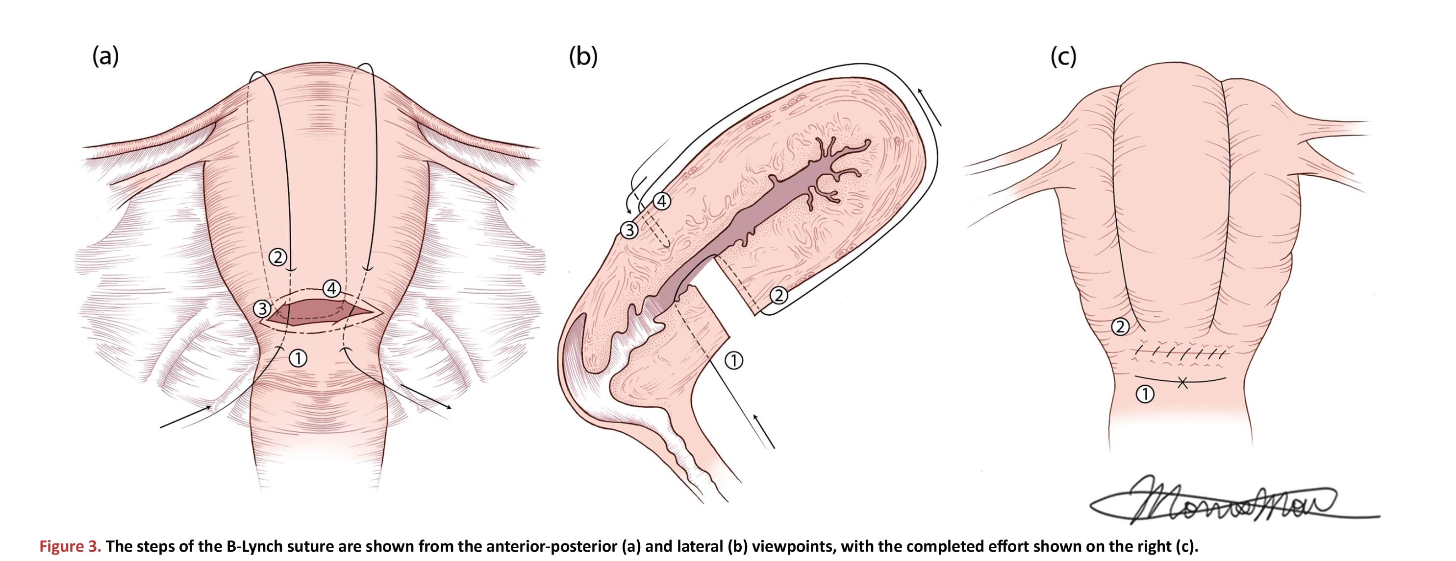 The steps of the B-Lynch suture