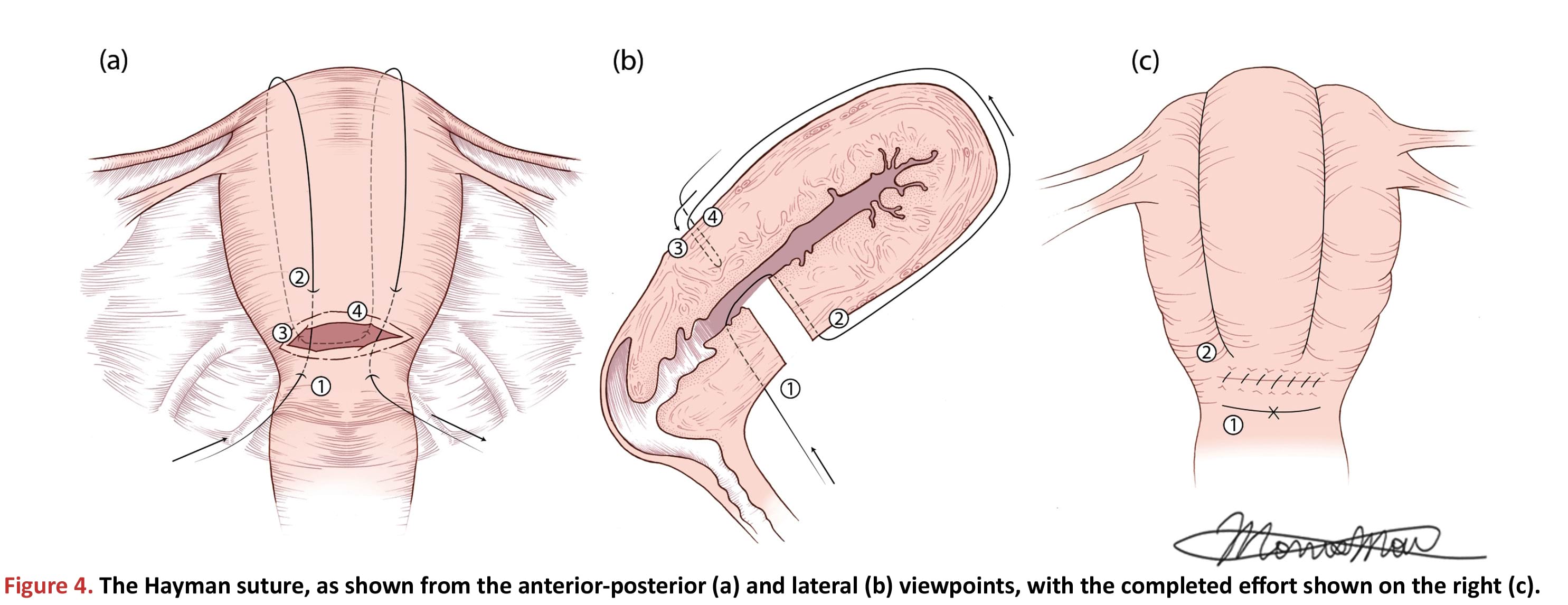 The Hayman suture