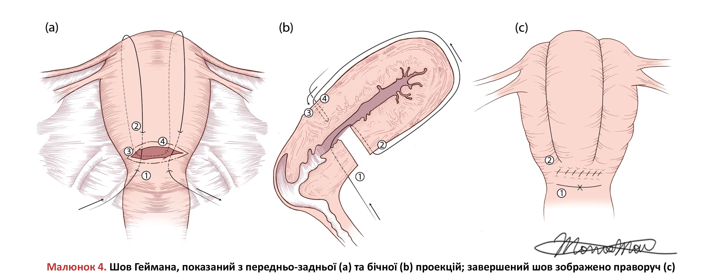 Шов Геймана