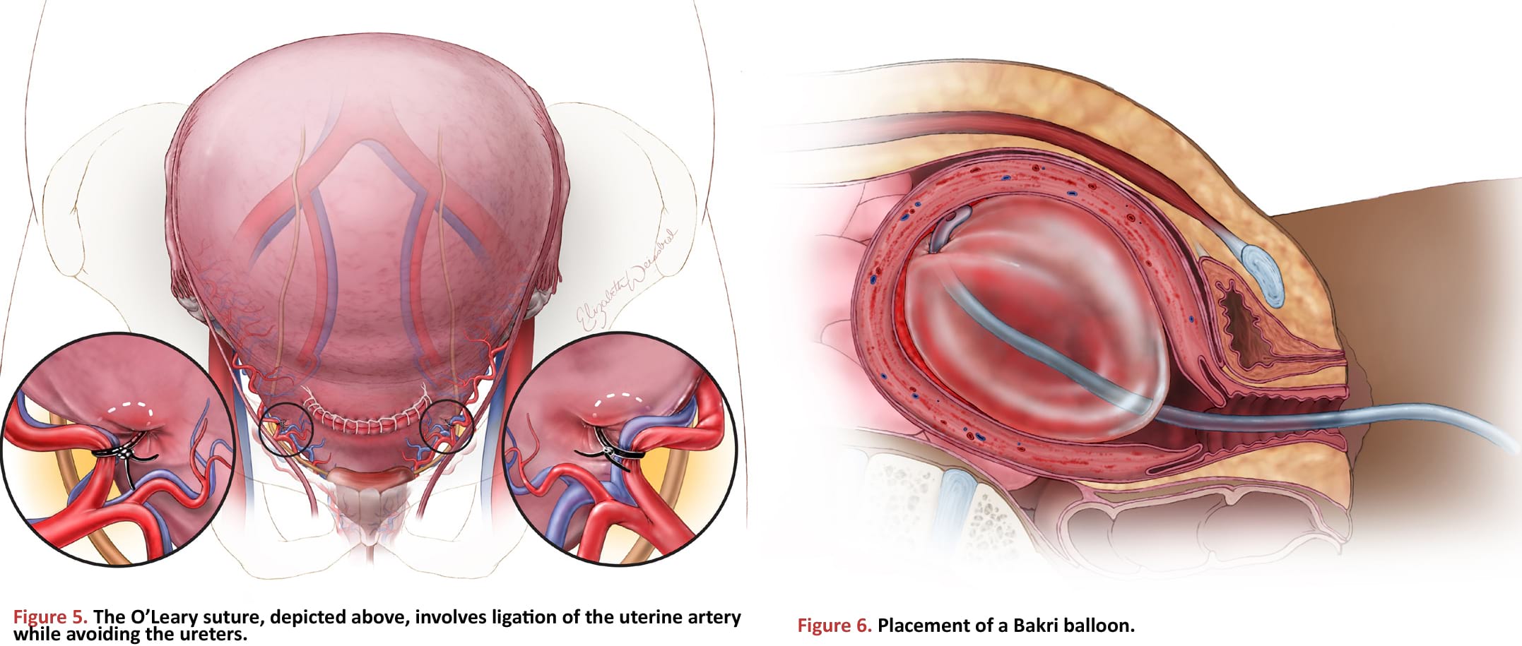 The O’Leary suture