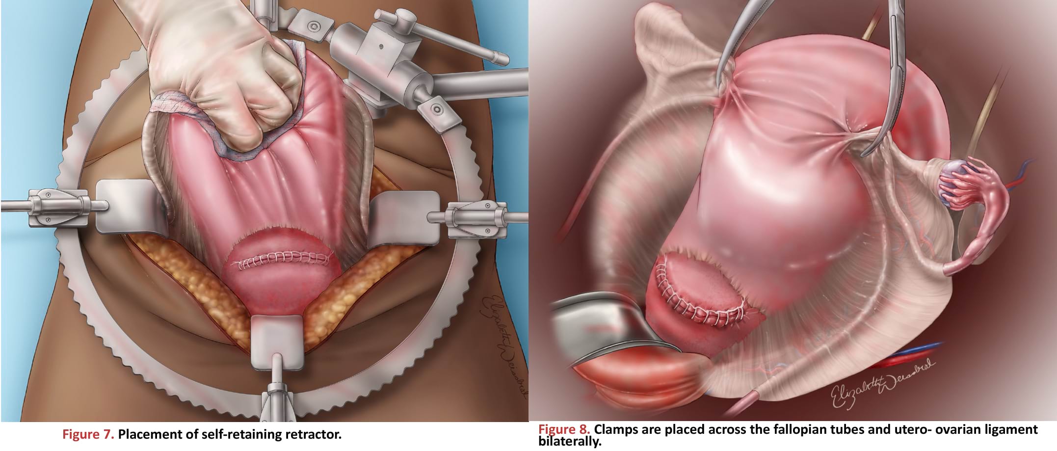 Placement of self-retaining retractor