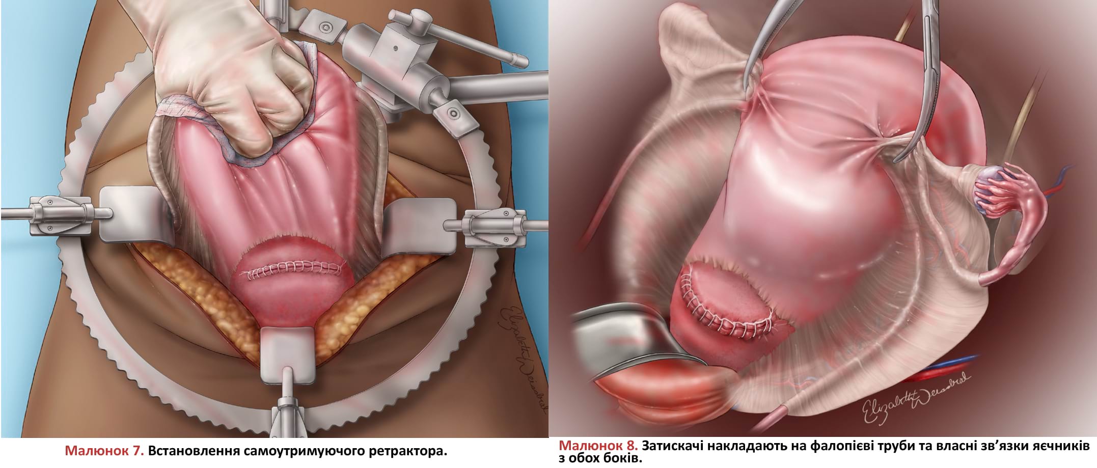 Встановлення самоутримуючого ретрактора