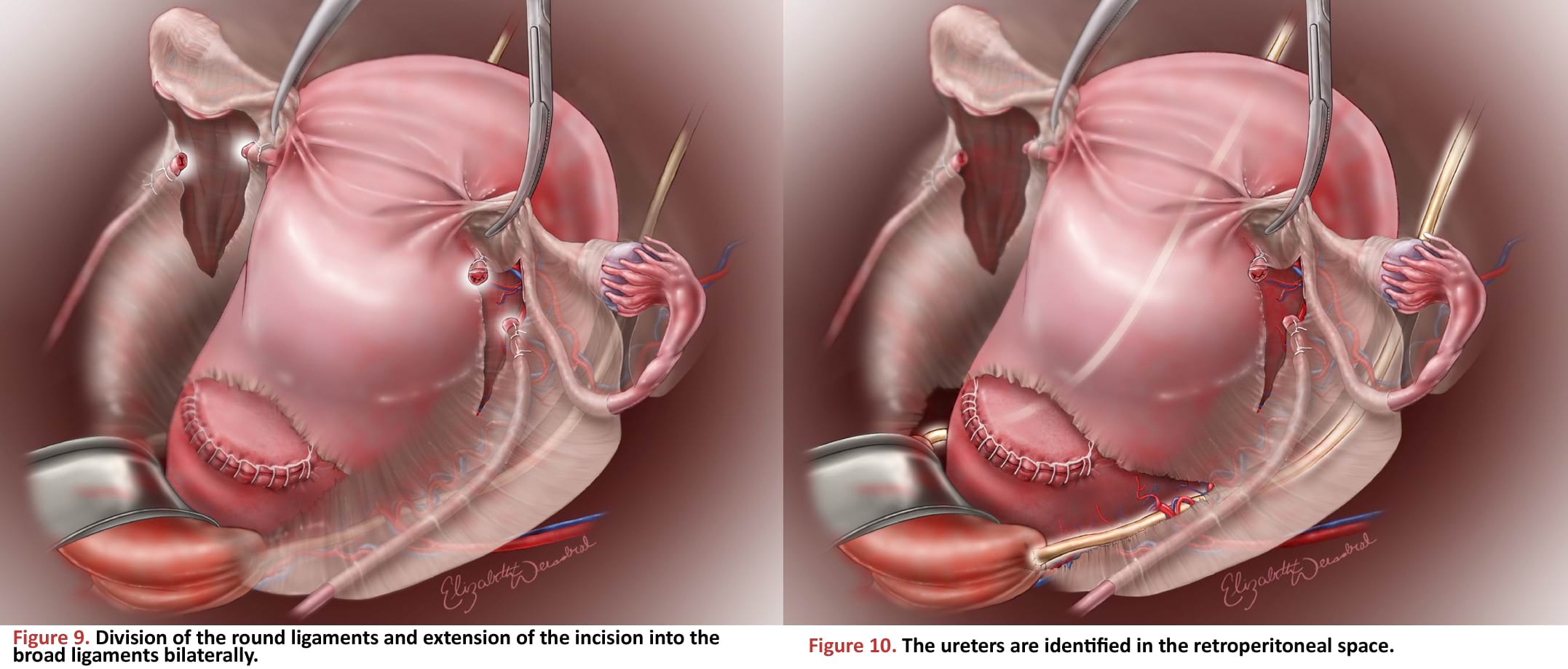 Division of the round ligaments and extension of the incision into the broad ligaments bilaterally