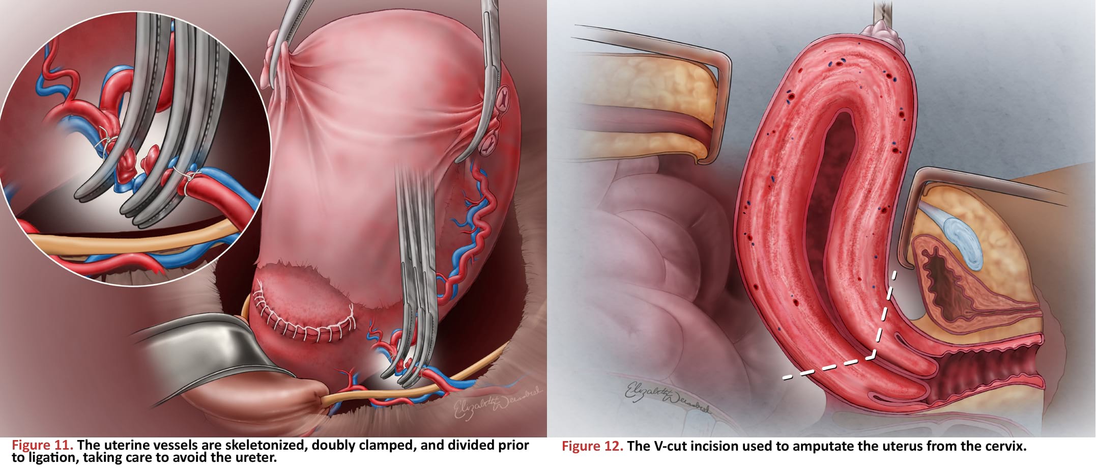 The uterine vessels are skeletonized, doubly clamped, and divided prior to ligation, taking care to avoid the ureter