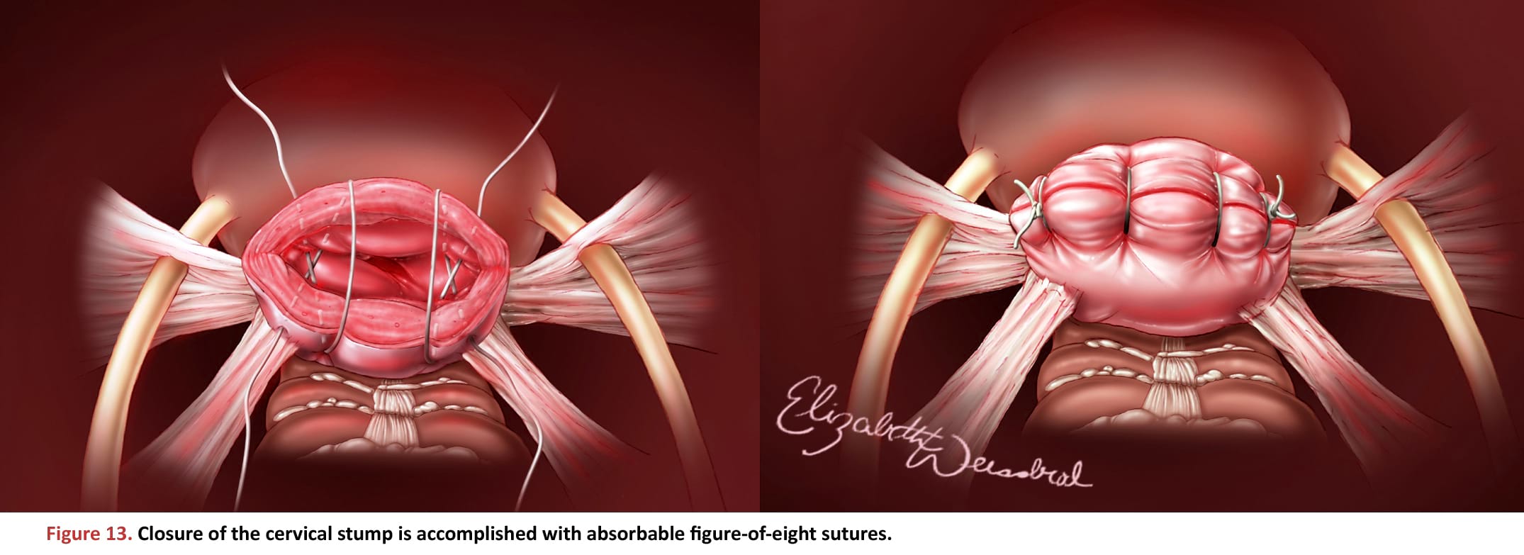 Closure of the cervical stump is accomplished with absorbable figure-of-eight sutures