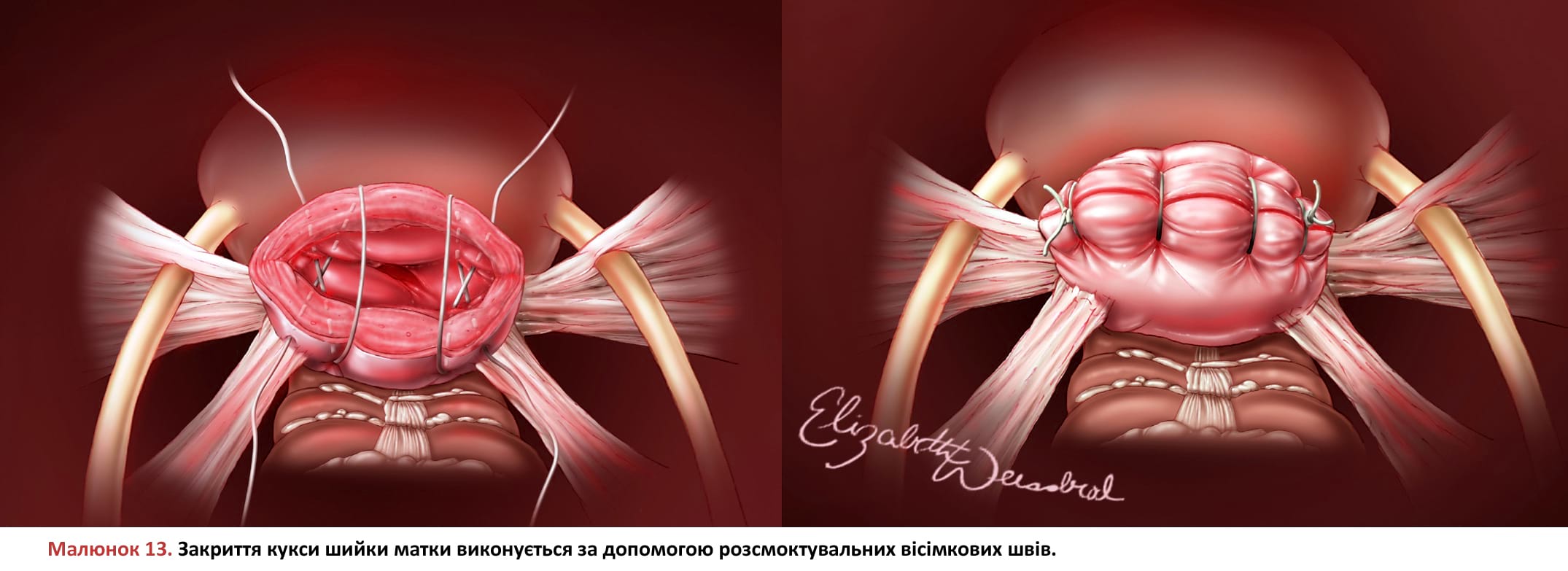 Закриття кукси шийки матки виконується за допомогою розсмоктувальних вісімкових швів