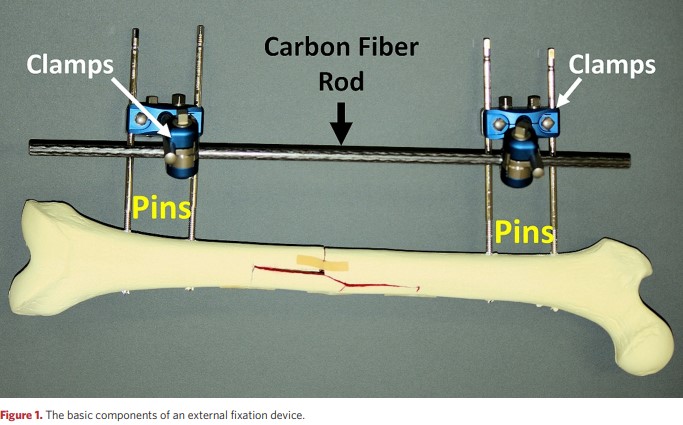 Main components of the external fixation apparatus