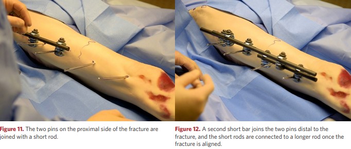 A second short rod connects the two rods distal to the fracture