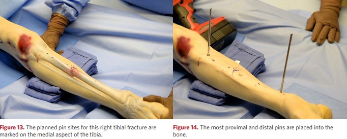 The rods are set into the bone