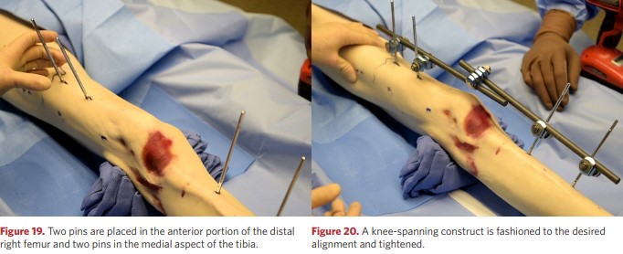 The knee fixation structure is moulded to the desired position of the limb