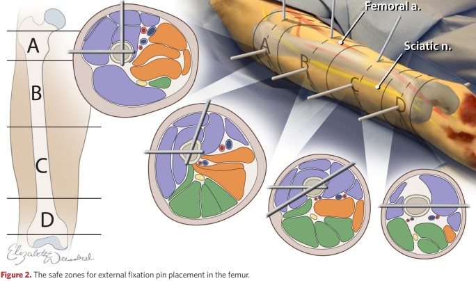 Safe areas for insertion of the external fixation rod into the femur