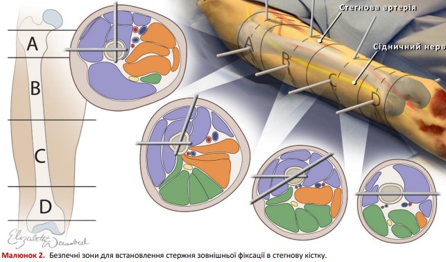 Безпечні зони для встановлення стержня зовнішньої фіксації в стегнову кістку