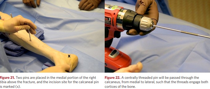 A rod with a central thread will be passed through the heel bone