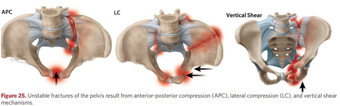 Consequences of unstable pelvic fractures