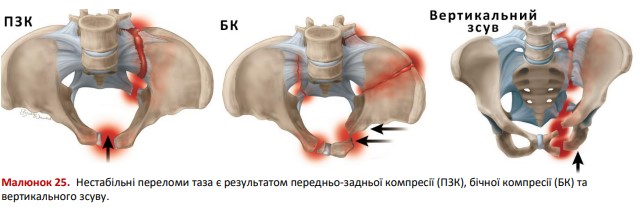 Наслідки нестабільних переломів тазу